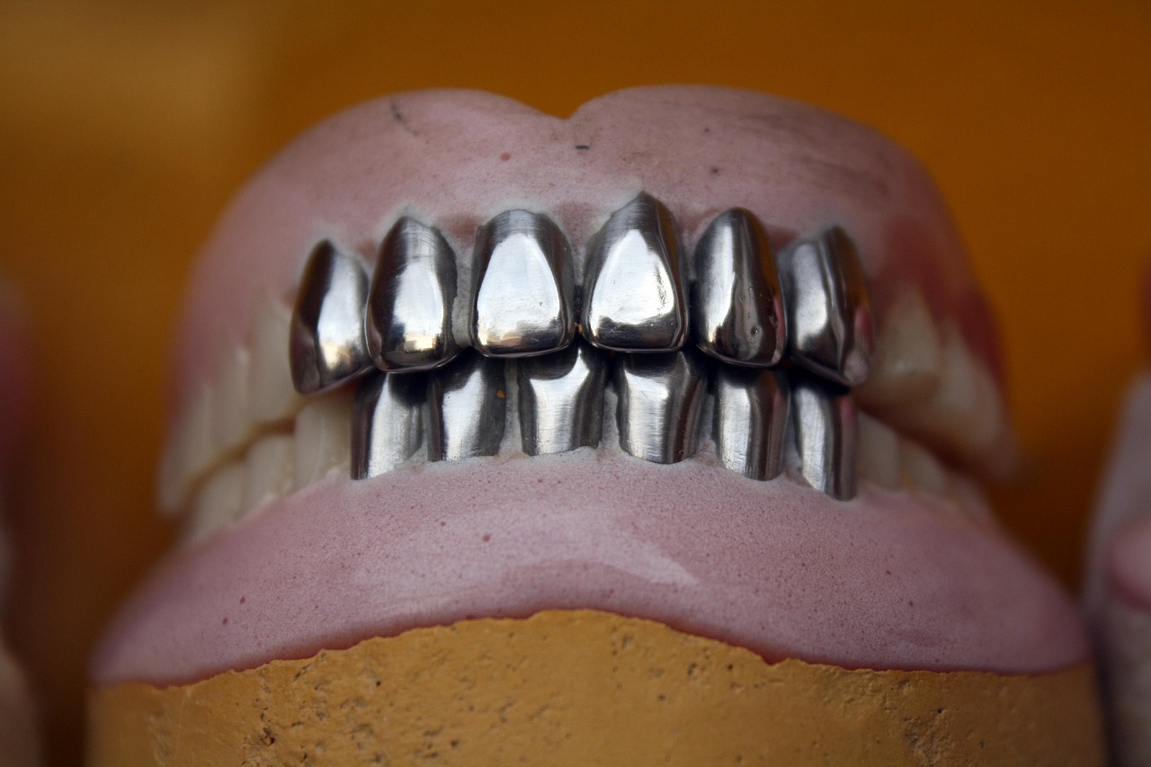 Metal teeth, dental, denture — Dental Implants Risks