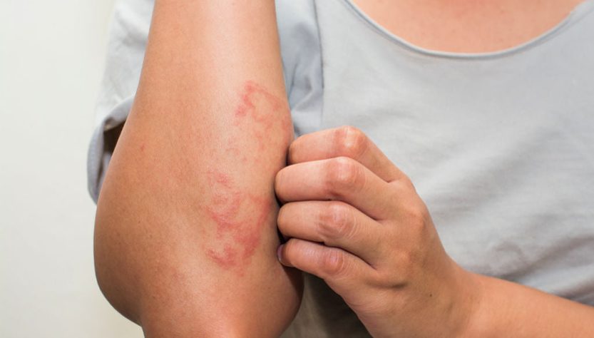 Why Switch to Natural Skincare for your Psoriasis